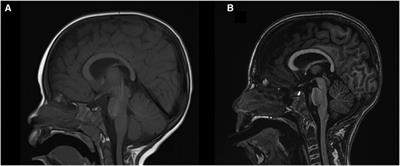 Two compound heterozygous variants in the CLN8 gene are responsible for neuronal cereidolipofuscinoses disorder in a child: a case report